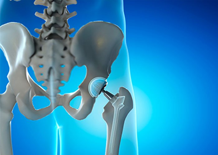 Joint Replacement Surgery